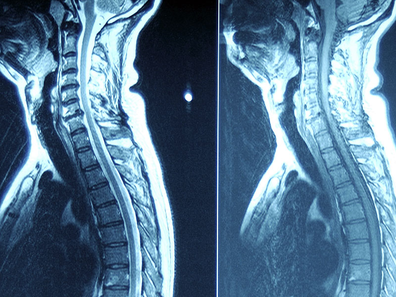Spine-xray.jpg